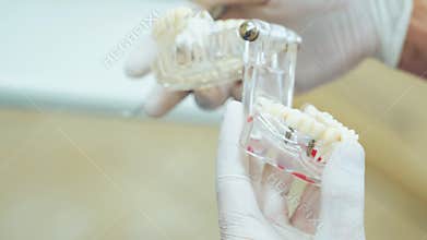 Demonstration of false teeth of implants on the layout of the jaw.
