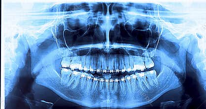 Dental radiography with braces