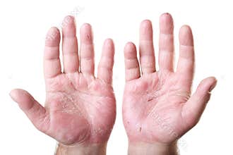 Two male palms with eczema isolated on white