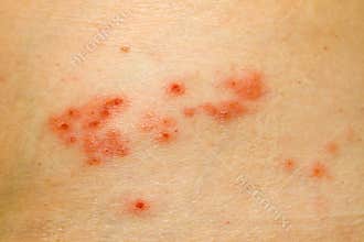 Shingles Rash