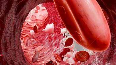 Hemostasis. Red blood cells and platelets in the blood vessel, vasoconstriction, wound healing process. hemorrhage clot