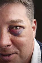 Black eye portrait