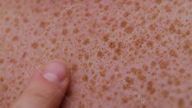 Extreme close-up of a finger examining human skin covered with numerous brown freckles or age spots.