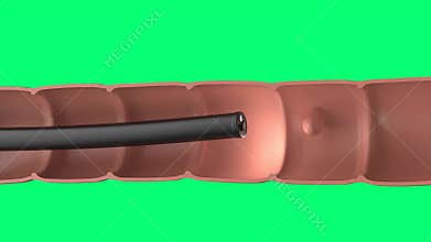 3d rendering endoscope with colonic polyp in intestine isolated on green screen