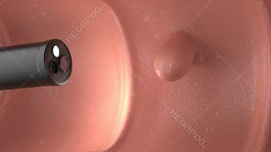 Medical technology with 3d rendering endoscope and colonic polyp in intestine