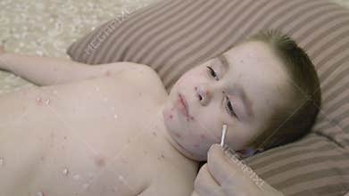 A child experiencing a skin condition chickenpox while at home understanding symptoms and care