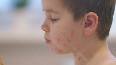 A child with skin conditions chickenpox showcasing remarkable resilience and strength in their journey