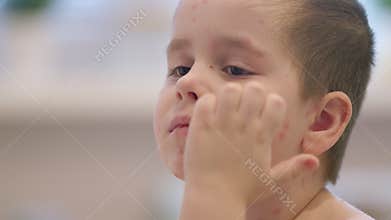 A child with a skin condition chickenpox posed beautifully in natural light, capturing innocence