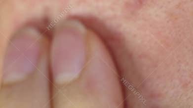 Macro shot of irritated facial skin with redness and acne. Highlights common skin problems and the need for proper