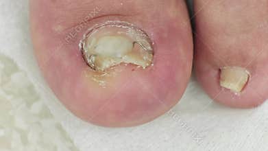 Demonstration of a 3TO titanium thread brace installed on a patient's toes close up. Podiatry and nail care