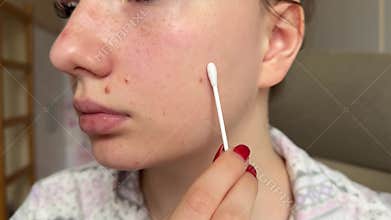 Skin care. Young woman apply the serum with a cotton swab to the pimple. Mask acne. Problem skin, acne, redness