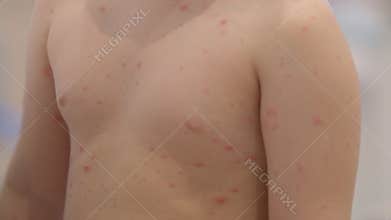 Child with Skin Rash Symptoms chickenpox Potential Viral Infection Indicating a Need for Care