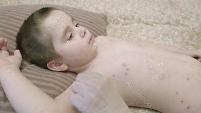 A young child with a skin condition chickenpox is lying on their bed, seeking care and rest