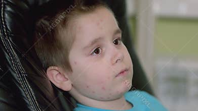 A child with a skin condition chickenpox, portrayed in a pensive and thoughtful pose, evokes empathy