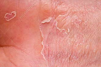 Eczema closeup