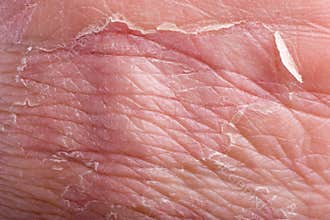 Eczema closeup