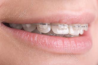 Braces on teeth