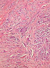Breast Cancer Histology