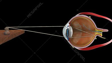 Hypermetropia normal eye