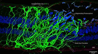 Microscopic View of Activated Mller Glia and Degenerating Photoreceptors with Gliotic Scar Formation in the Retina