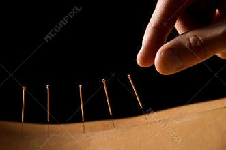 Acupuncture