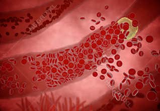 Clogged Artery with platelets and cholesterol plaque, concept for health risk for obesity or dieting and nutrition problems