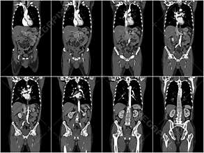 Human body on CT scans