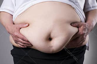 Obesity woman body, fat female belly with a scar from abdominal surgery close up
