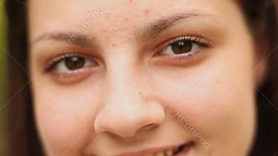 Teen girl face with acne close-up. On the face of acne. Brown eyes