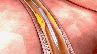 Coronary angioplasty