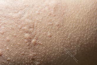 Urticaria or allergy rash
