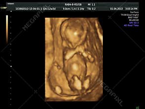 4D Baby ultrasound scan