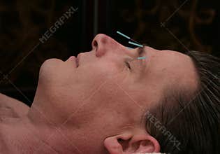 Facial Acupuncture
