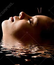Acupuncture
