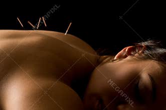 Acupuncture