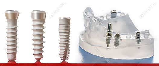 Dental implants