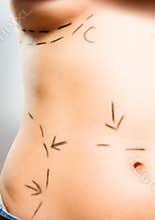 Correction cosmetic surgery