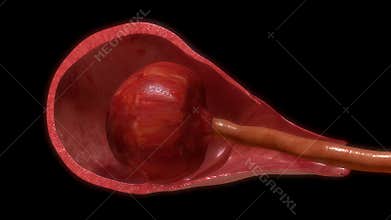 Pulling placenta out of uterus