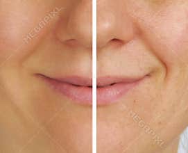 Correction of wrinkles on half of face