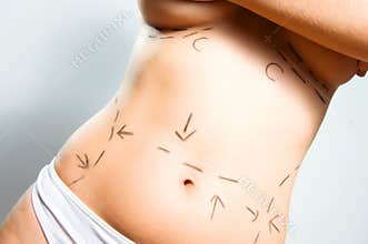 Breast augmentation and abdominal surgeries