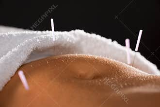 Acupuncture belly