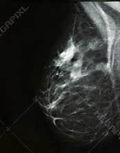 Breast cancer