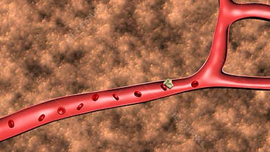 Animation of the formation of thrombosis