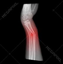 X-ray of broken arm