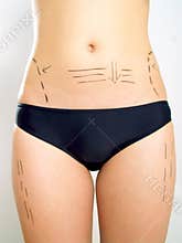 Abdomen, waist, thigh marked for plastic surgery