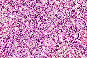 Hepatocellular carcinoma - liver cancer in rat, 60x zoom