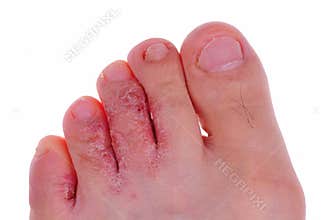 Athlete's foot fungus