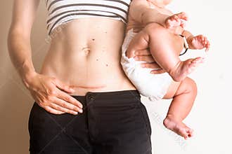 C section Cesarean operation heal after