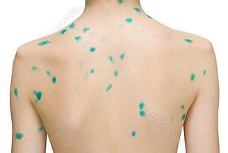 Chicken pox