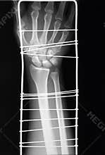 X-ray of distal arm and immobilisation, fracture?